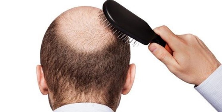 تبلیغاتی برای کسب درآمد کاشت مو تقویت مو
