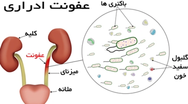 عفونت ادراری