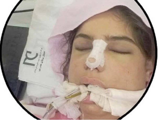 سحر اسکندری دختر 18 ساله عمل جراحی بینی مرگ بعد از جراحی زیبایی بینی