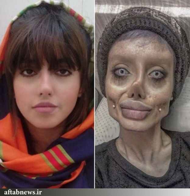 سحر تبر قبل و بعد از عمل زیبایی