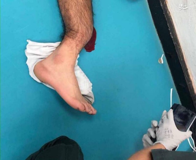 تصویر دردناک از شکستن پای آندره گومز