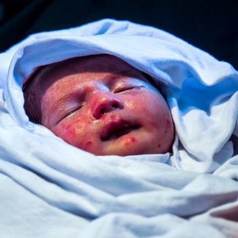 نوزاد مبتلا به بیماری ای بی (e.b) یا بیماری پروانه ای